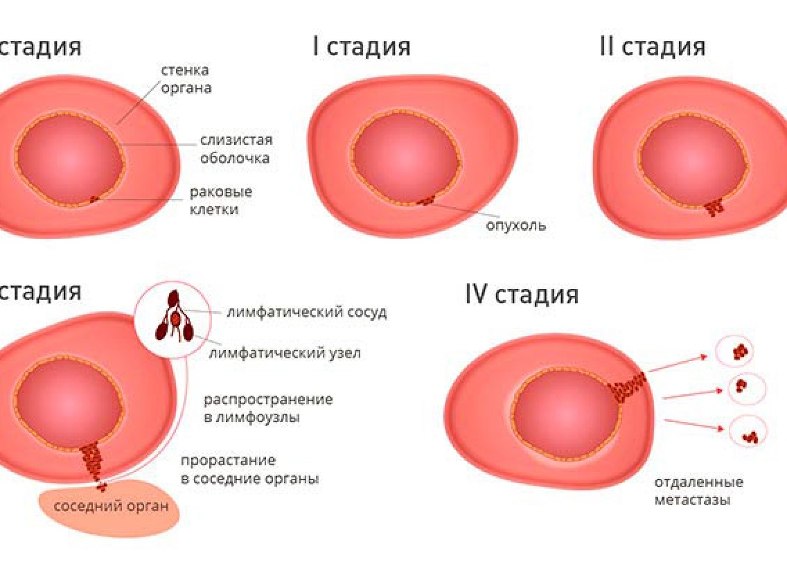 Сколько может прожить человек с метастазами в головном мозге? Сколько может прожить человек с метастазами в головном мозге?